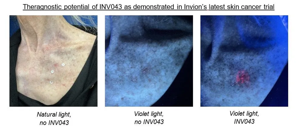 The theragnostic potential of Invion's INV043.